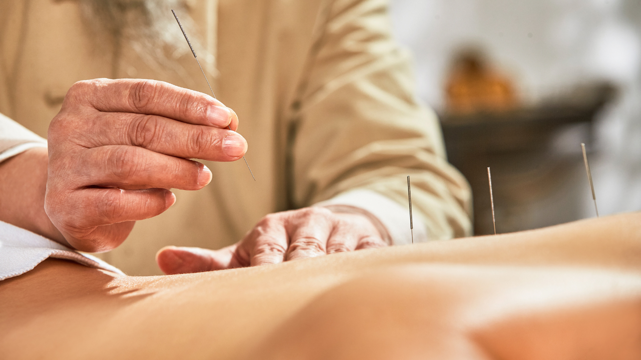 Akupunktura